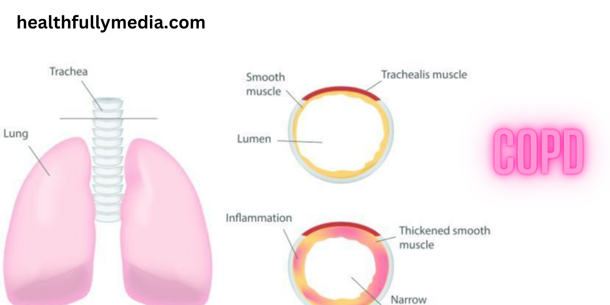 COPD SYMPTOMS