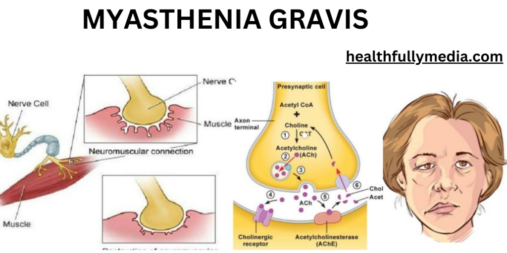 What Is Myasthenia Gravis What Is Myasthenia Gravis