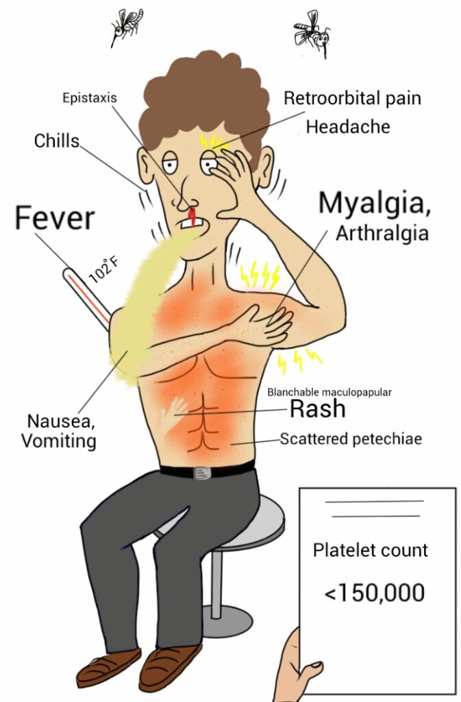 DENGUE FEVER SYMPTOMS