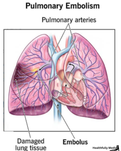 Pulmonary Embolism